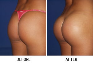Buttock Augmentation