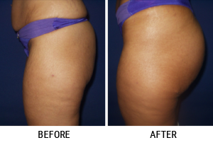 Liposuction
