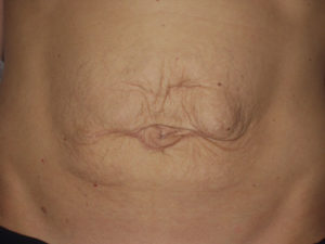 Abdominoplastika - Pacijent 1