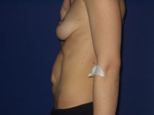 Abdominoplastika - Pacijent 1