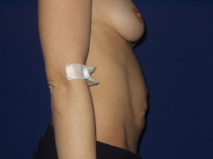 Abdominoplastika - Pacijent 1