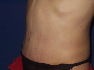 Abdominoplastika - Pacijent 1