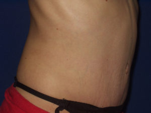 Abdominoplastika - Pacijent 1