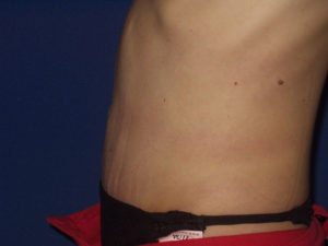 Abdominoplastika - Pacijent 1