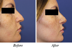 nose correction - patient 4
