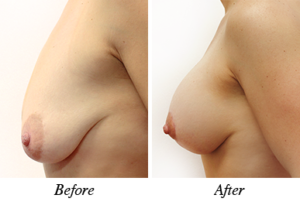Breast lift, augmentation and correction - patient 17