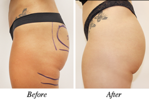 Buttock augmentation- patient 2