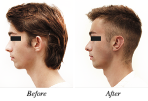 Ear reshaping before and after - patient 2