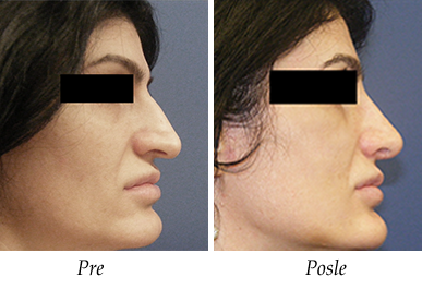 Korekcija nosa - pacijent 9 Korekcija nosa - Pacijent 9