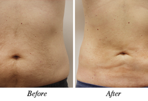 Liposuction before and after