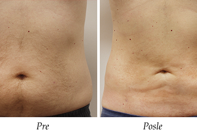 Liposukcija - pre i posle