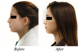 Nose correction - Patient 17