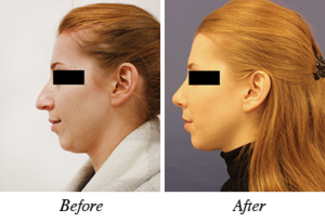 Nose correction - patienet 10
