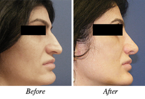 Nose correction - patient 9