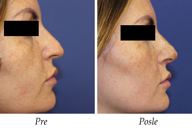 Korekcija nosa - pacijent 4 korekcija nosa pacijent 4