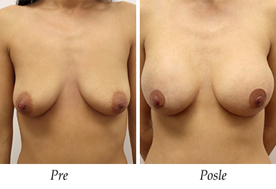 Pacijent 14 - pre i nakon uvećanja grudi