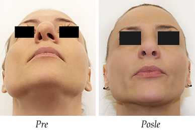 Pacijent 19 - Pre i posle korekcije nosa Pacijent 19 - Pre i posle korekcije nosa