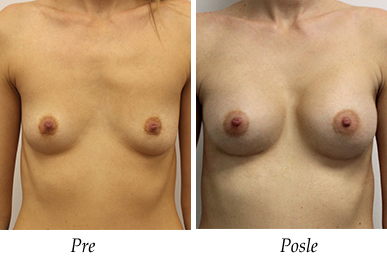 Pacijent 23 - pre i nakon uvećanja grudi