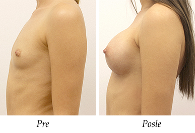 Pacijent 26 - pre i nakon uvećanja grudi