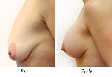 Podizanje i korekcija grudi - pacijent 17