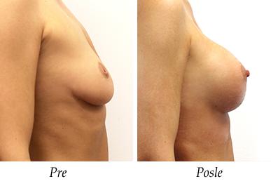 Uvećanje grudi i korekcija bradavice