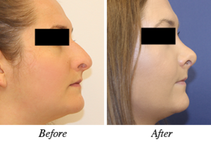 Nose correction before-after patinet 8