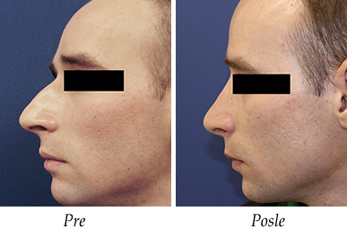 Korekcija nosa - pacijent 6 devijacija nosa