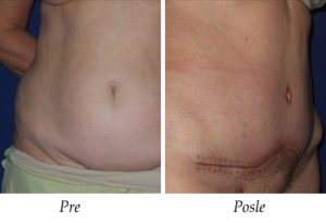 Galerija Pre i Posle: Abdominoplastika