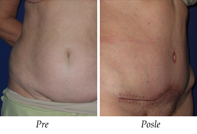 Abdominoplastika