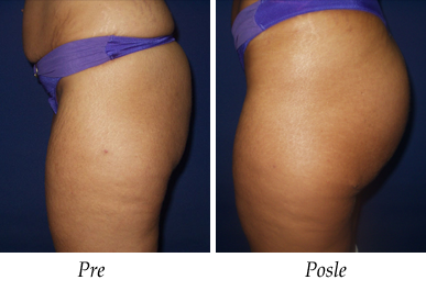 Liposukcija – Pacijent 01