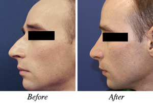 nose correction