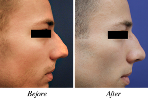 nose correction before after