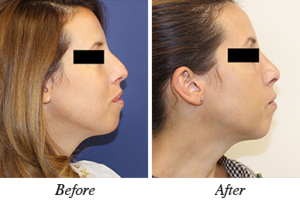 nose correction - before after