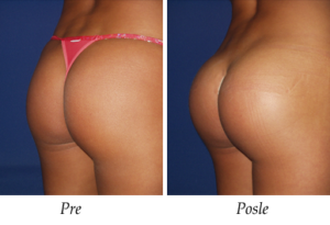 Galerija Pre i Posle - Uvećanje zadnjice