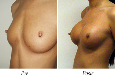 Pre i nakon uvećanja grudi - pacijent 06