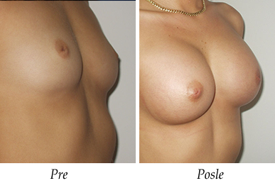 Pre i nakon uvećanja grudi - pacijent 07