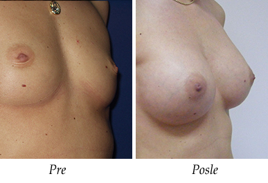 Pre i nakon uvećanja grudi - pacijent 08