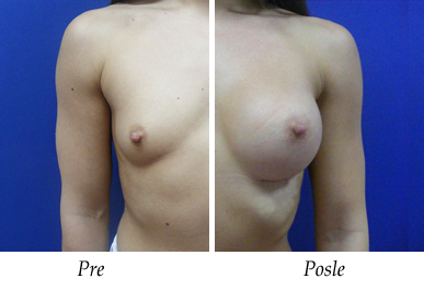 Pre i nakon uvećanja grudi - pacijent 05