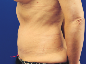 Abdominoplasty - patient 3