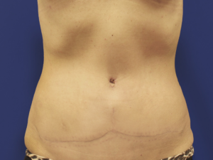 Abdominoplasty - patient 3