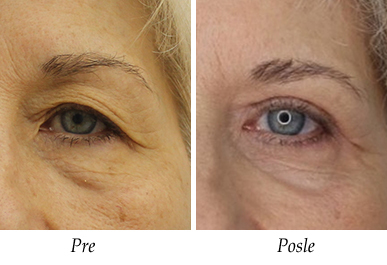 Pacijent 6 - Pre i nakon korekcija kapaka