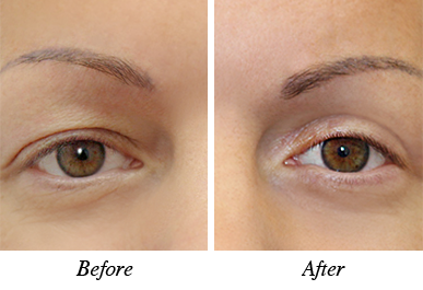 Patient 3 - Before and after intervention