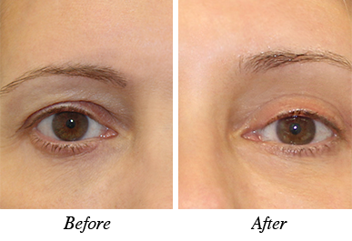 Patient 4 - Before and after intervention