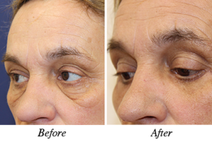 Blepharoplasty