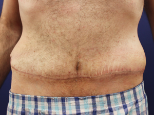 Abdominoplastika pre i posle 