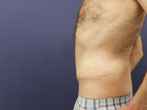 Abdominoplastika pre i posle