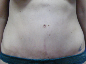 mommy makeover after