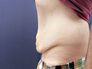 Abdominoplastika pre i posle