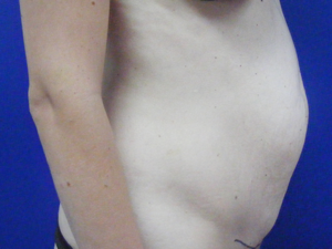 Mommy makeover before