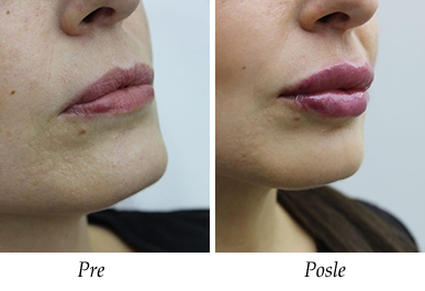 Galerija Pre i Posle - Korekcija ušiju pacijent 1